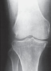 変形性膝関節症のＸ線重症度分類イメージ