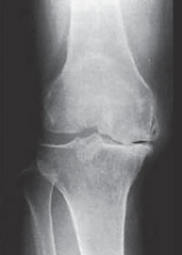 変形性膝関節症のＸ線重症度分類イメージ
