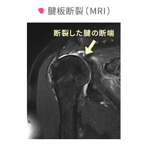 五十肩・肩関節周囲炎イメージ