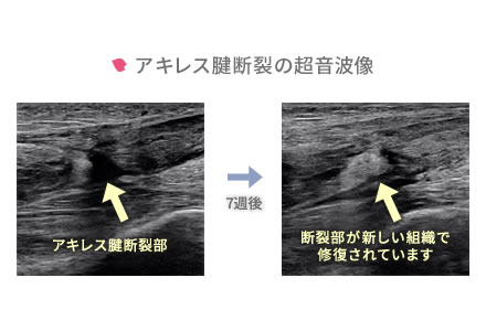 スポーツによるケガイメージ